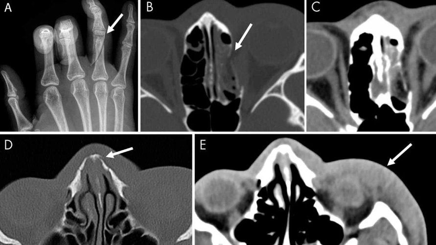 Los radiólogos pueden identificar signos de agresiones y alertar sobre una víctima