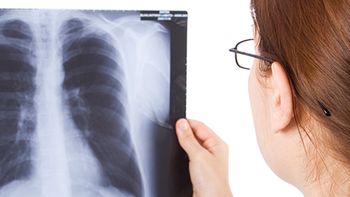 Los casos de tuberculosis aumentaron un 38% y continúan en ascenso en Argentina
