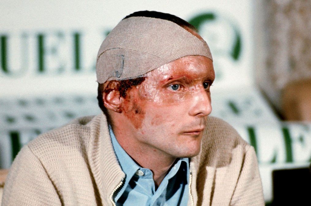 Solo 42 días después del accidente, Lauda dejó al mundo boquiabierto al tomar parte del GP de Italia, y nadie podía creer que volviera a correr luego del infierno que debió atravesar. Su oreja derecha no existía más, devastada por el fuego. No tenía más cejas y, debajo de la gorra, varias vendas cubrían las quemaduras sufridas en el cuero cabelludo.