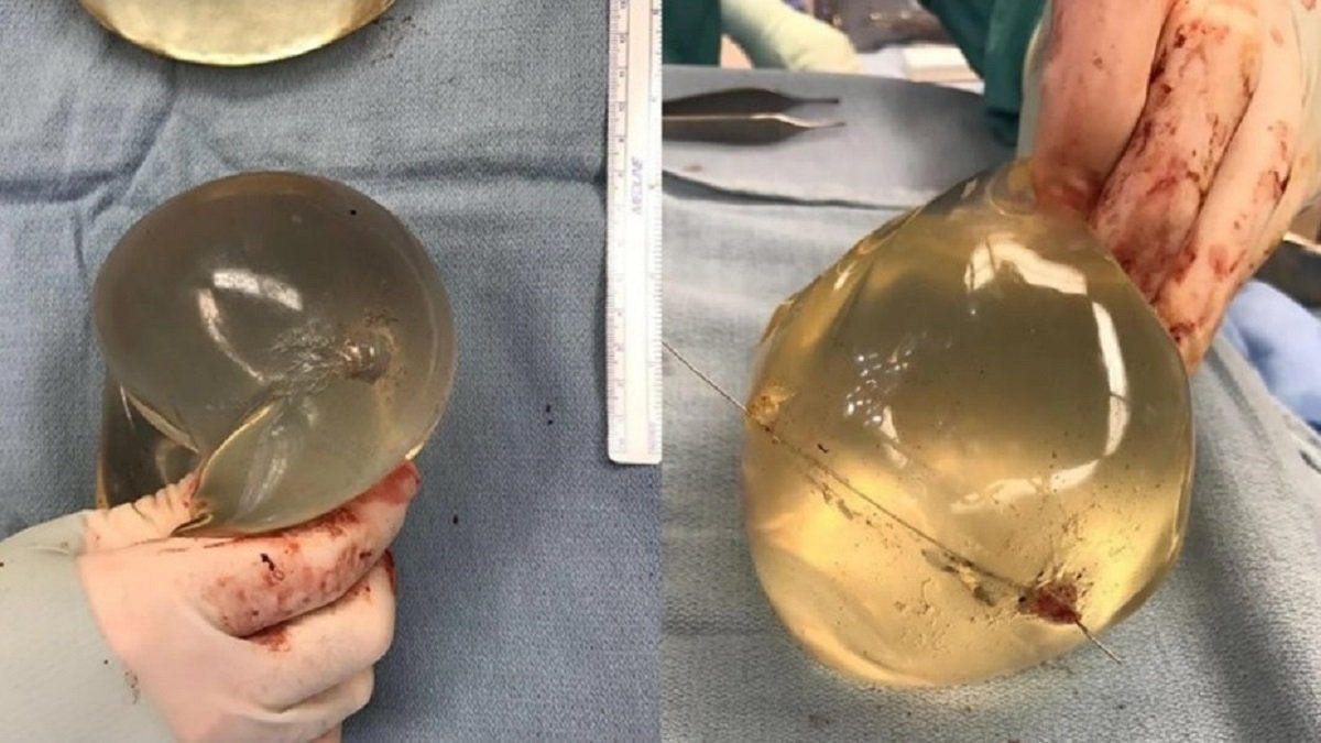 La muestra de los&nbsp;implantes de siliconas que le salvaron la vida.