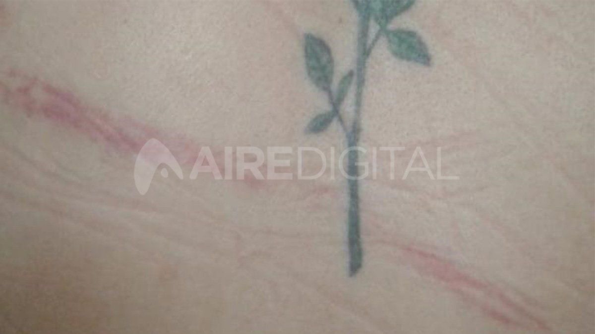 Una de las tantas marcas que el agresor dejó sobre el cuerpo de Vanesa