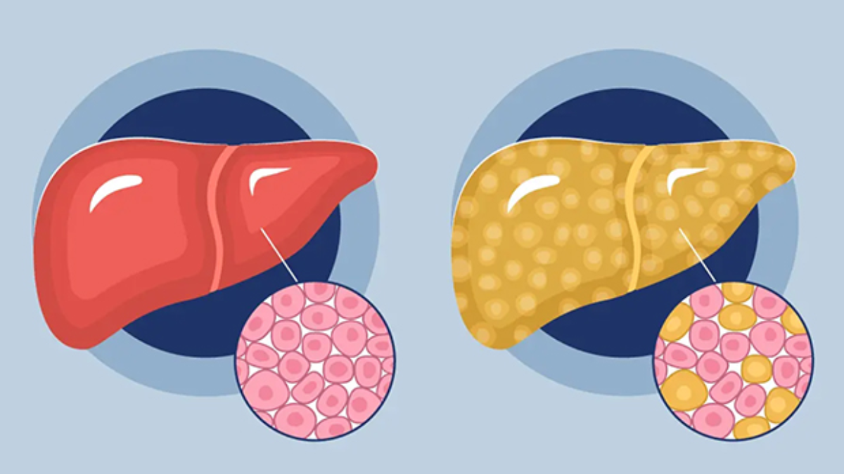 El proceso de inflamación en las células hepáticas es el primer paso hacia el desarrollo de enfermedades más graves como la fibrosis. El proceso de inflamación en las células hepáticas es el primer paso hacia el desarrollo de enfermedades más graves como la fibrosis.