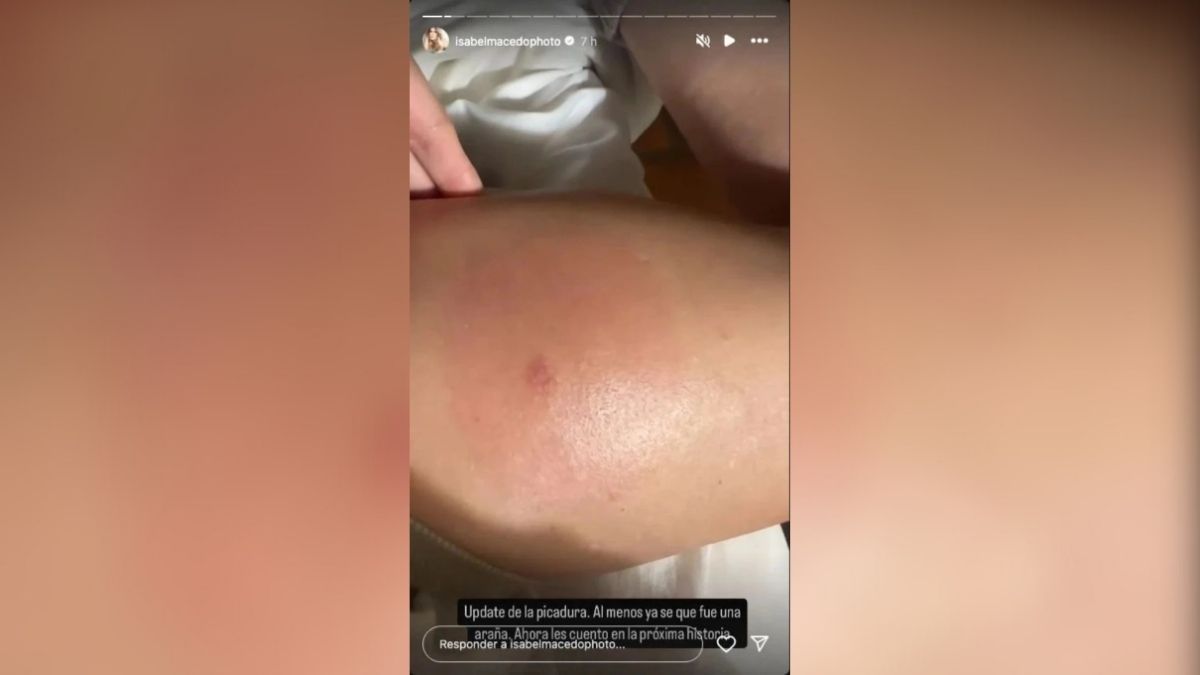 Isabel Macedo sufre por la picadura de una araña. Isabel Macedo sufre por la picadura de una araña.