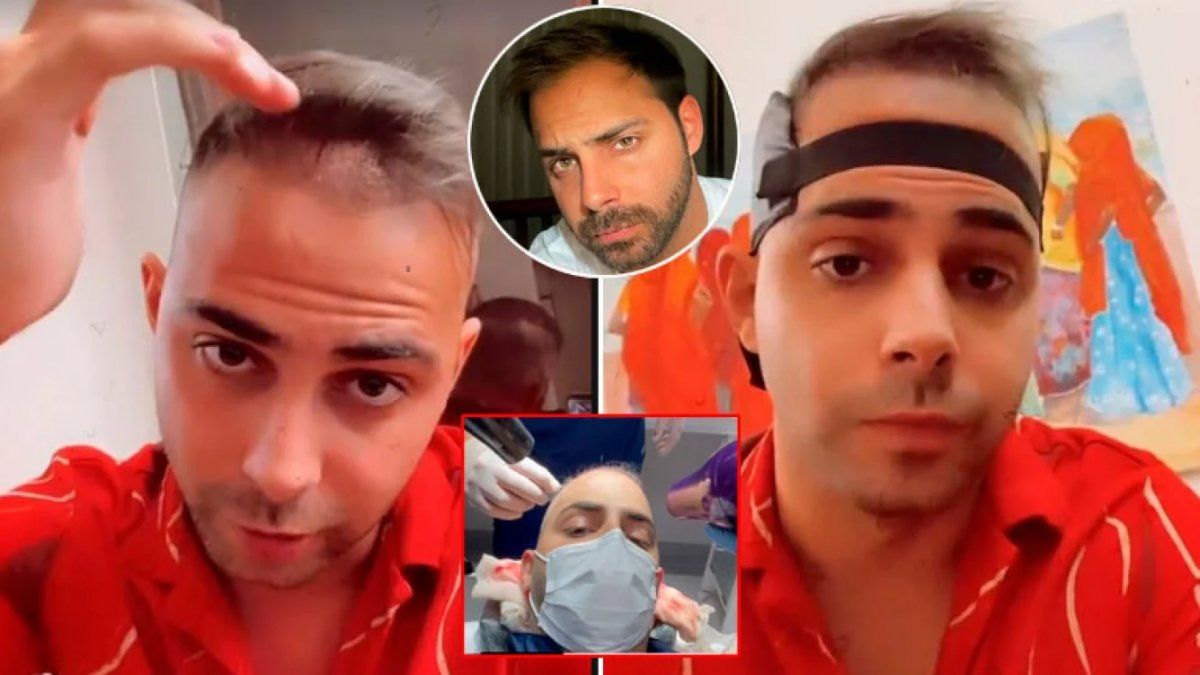 Grego Rossello se hizo un implante capilar por canje