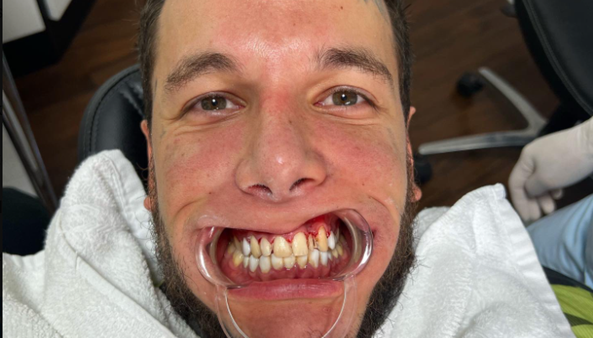 Alex Cannigia con dientes nuevos y polvo blanco en la nariz: L-gante