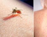 confirman 680 casos de dengue autoctono y 156 de sarampion confirman 680 casos de dengue autoctono y 156 de sarampion