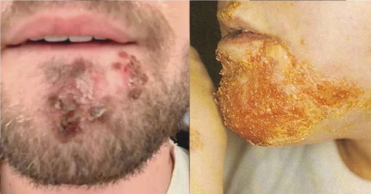 Usó una afeitadora prestada