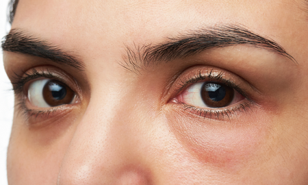 5 remedios naturales y efectivo para tratar las ojeras