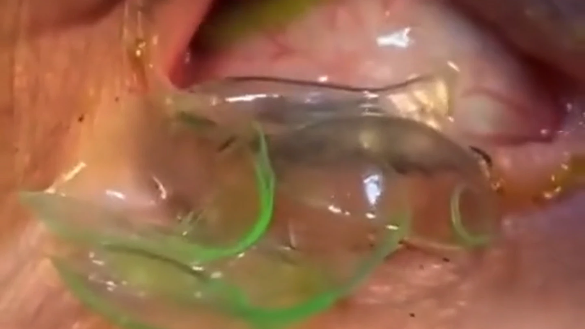 La mujer tenía 23 lentes de contacto en el ojo y no sabía que debía sacárselas cada día. (Video de TikTok Mohammed Alanazi @dr9)