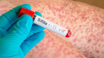 En la provincia de Santa Fe se registraron más de 4.200 casos de sífilis en lo que va de 2025