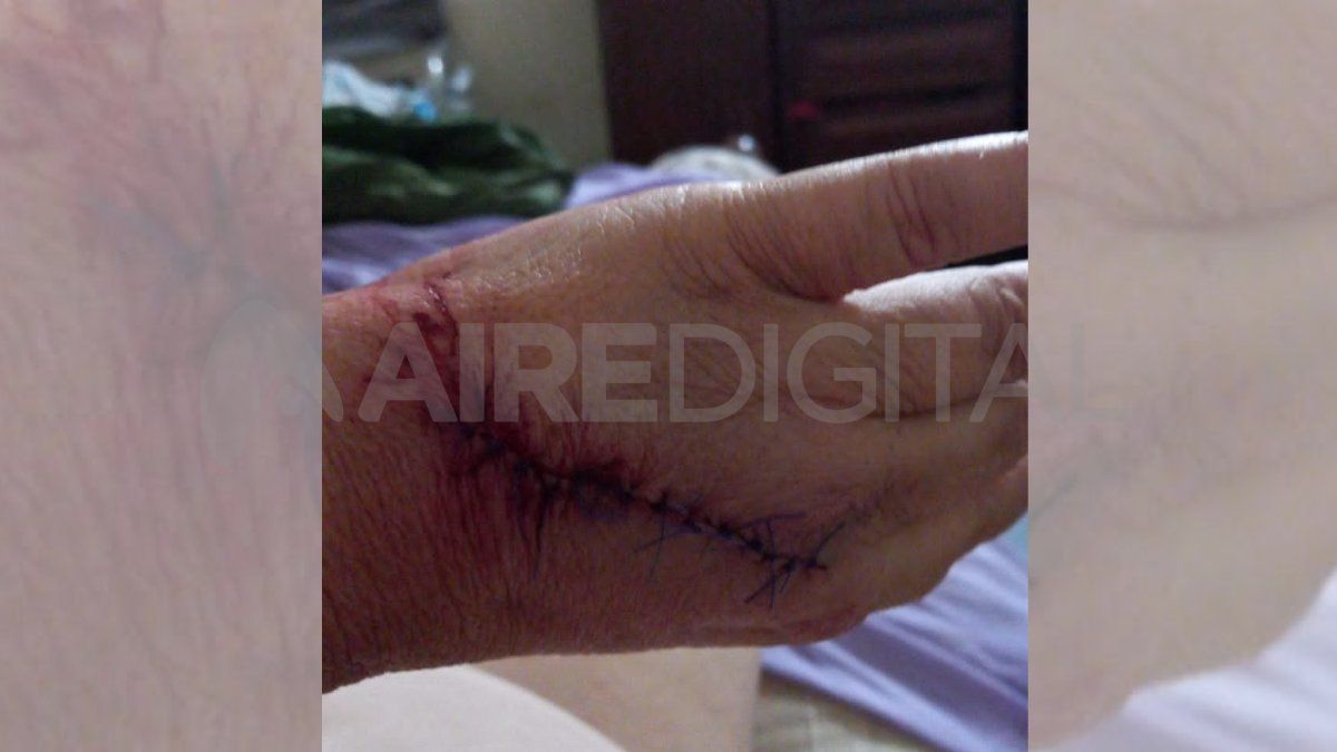 La mujer fue atacada con un machete que le dejó una herida profunda en una mano