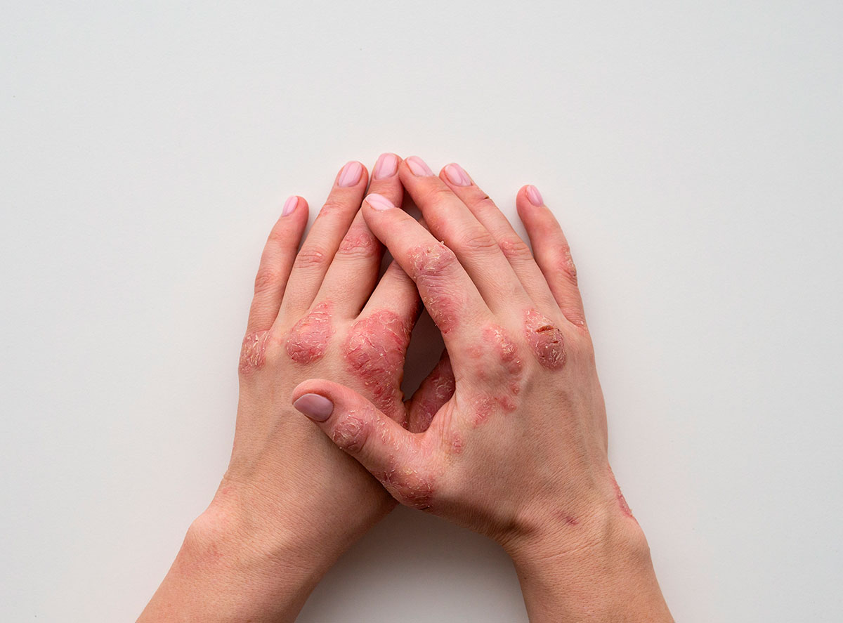 Día Internacional de la Psoriasis: ¿por qué se conmemora el 29 de octubre?