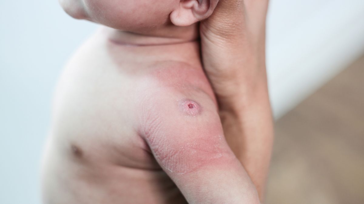 En Argentina, la vacuna Triple Viral (SRP), que protege contra el sarampión, la rubéola y las paperas, está incluida en el calendario oficial de vacunación. En Argentina, la vacuna Triple Viral (SRP), que protege contra el sarampión, la rubéola y las paperas, está incluida en el calendario oficial de vacunación.