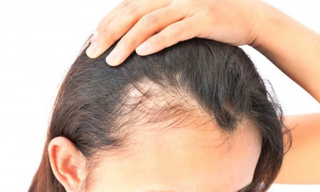 El estrés, las hormonas y la genética son los factores más comunes detrás de la caída del cabello. El estrés, las hormonas y la genética son los factores más comunes detrás de la caída del cabello.