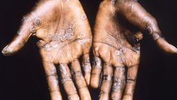 Viruela del mono en Argentina.