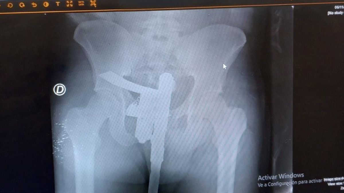 Así detectaron el arma de fuego en el hospital Cullen.