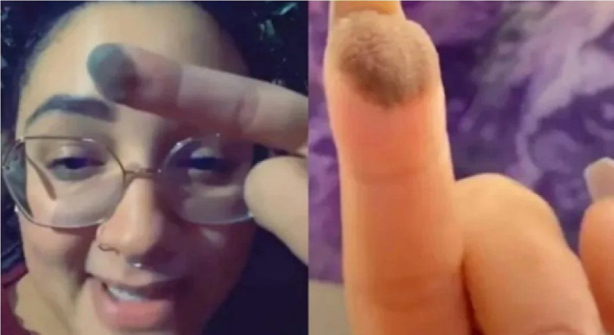 Le injertaron piel en la mano y ahora le crece vello púbico en la yema del dedo