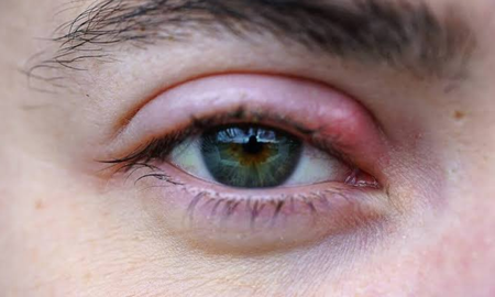 El Staphylococcus aureus es la bacteria más común asociada a la inflamación e infección del folículo palpebral. El Staphylococcus aureus es la bacteria más común asociada a la inflamación e infección del folículo palpebral.