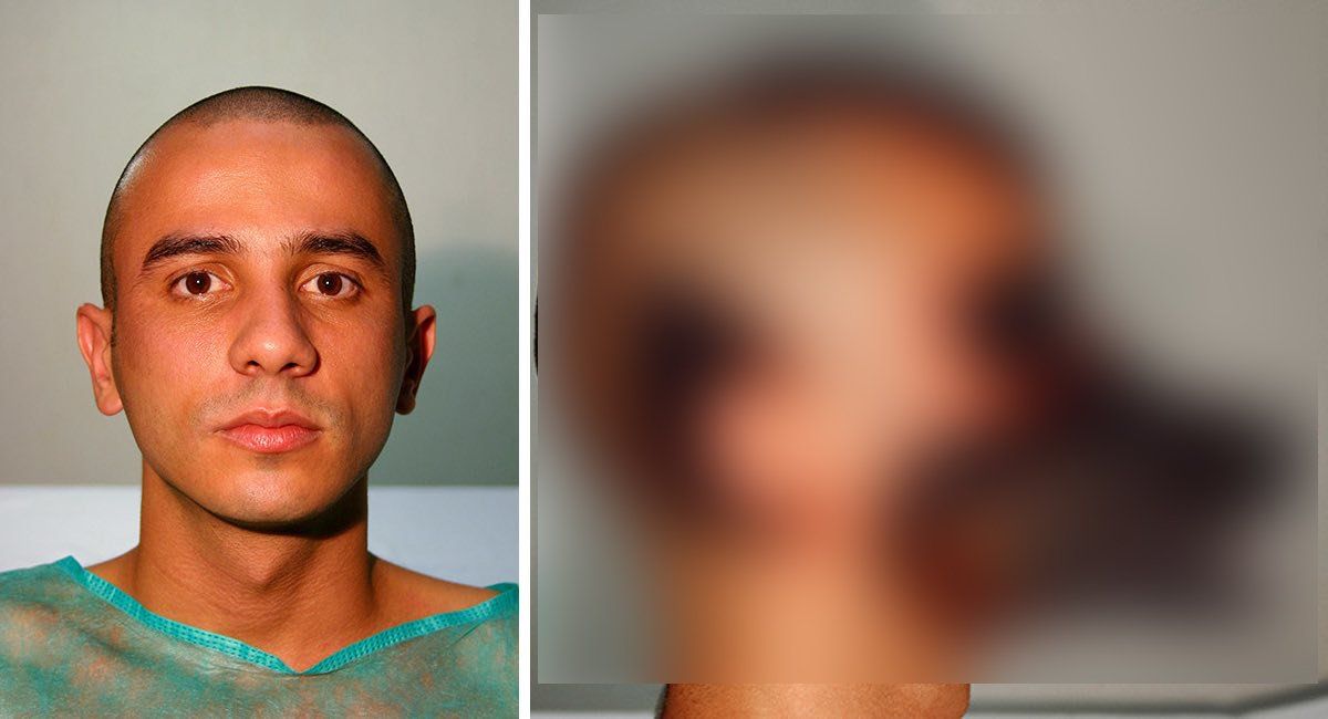 Mitad humano, mitad perro: La verdad del hombre que se “transplantó” la cara de un animal