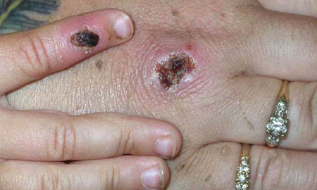Viruela del mono: Inglaterra informó el primer caso de una rara enfermedad Viruela del mono: Inglaterra informó el primer caso de una rara enfermedad