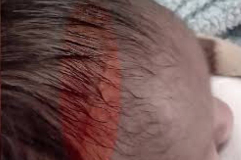 El pequeño quedó con una cicatriz de 15 cm en su cabeza Foto: Impresión de pantalla Canal 13 puebla