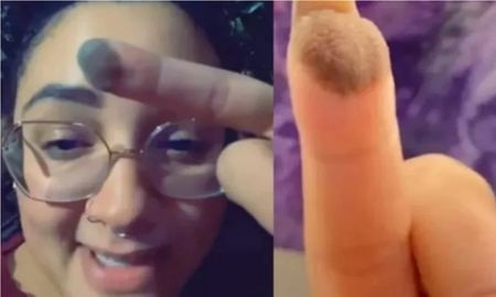 Le injertaron piel en la mano y ahora le crece vello púbico en la yema del dedo Le injertaron piel en la mano y ahora le crece vello púbico en la yema del dedo