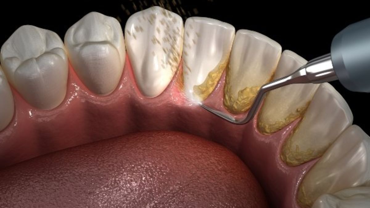 La mejor forma de eliminar y prevenir el sarro de los dientes.