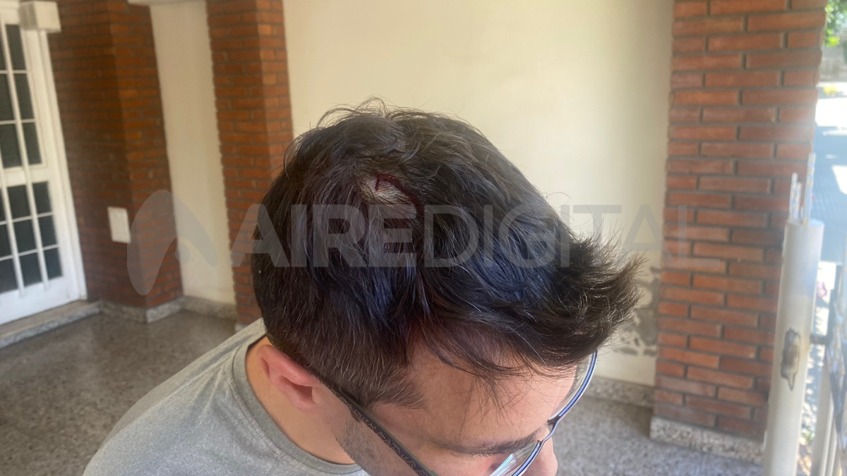 Los delincuentes atacaron a culatazos a Alejandro