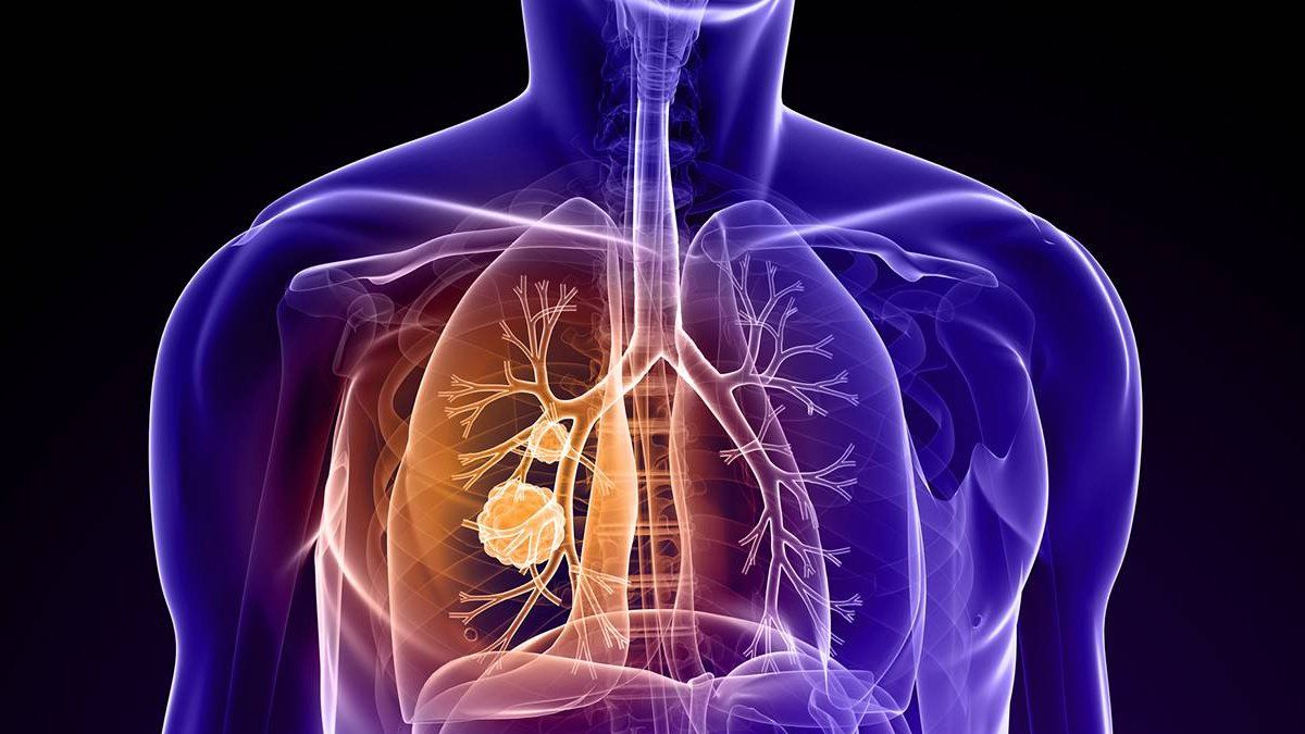 &nbsp;Las estadísticas señalan que en la Argentina por cada 100.000 habitantes 19 mueren por cáncer de pulmón.