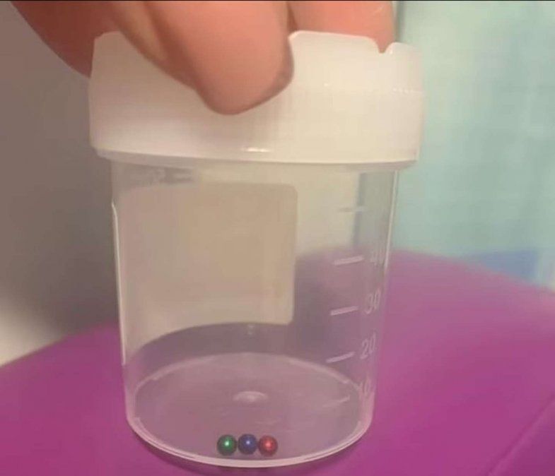 Tres de las bolitas magnéticas que le sacaron al nene de 11 años.