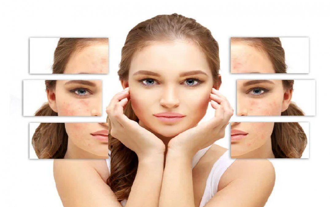 Cómo quitar granos de la cara sin dejar ninguna marca