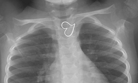 La curiosa razón por la que la radiografía de esta nena muestra un corazón dibujado a la perfección en su pecho