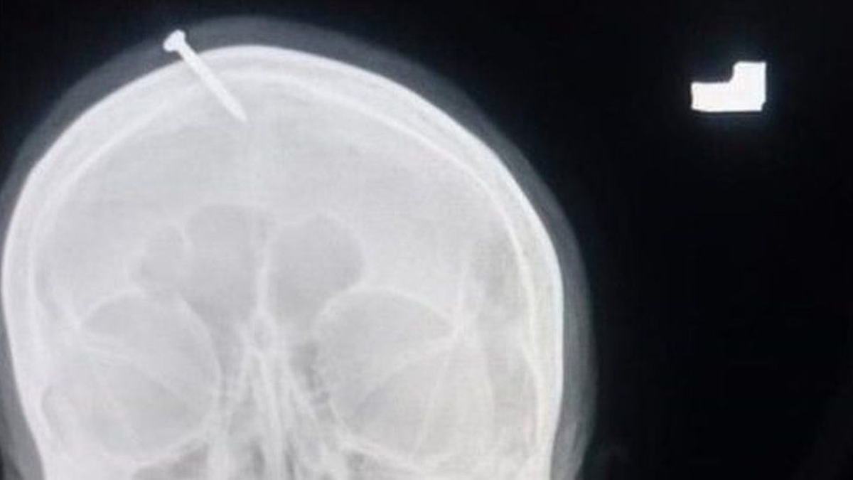 Una radiografía muestra el clavo clavado en la cabeza de la mujer