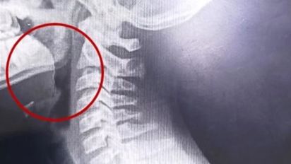 Merienda de terror en Mar del Plata: comió una galletita, escupió sangre y el hallazgo causó impacto