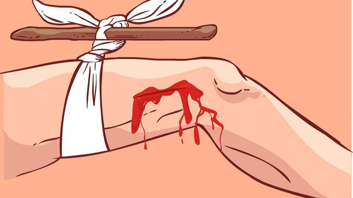 Cómo realizar un torniquete para detener una hemorragia. Cómo realizar un torniquete para detener una hemorragia.