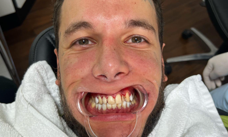 Alex Cannigia con dientes nuevos y polvo blanco en la nariz: L-gante, estoy igual que vos Alex Cannigia con dientes nuevos y polvo blanco en la nariz: L-gante, estoy igual que vos