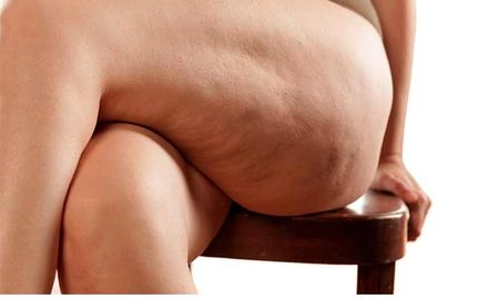 13 tips para eliminar la celulitis