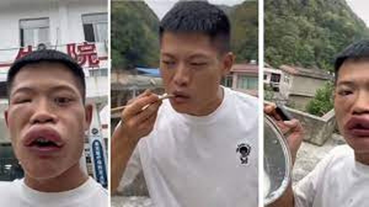 Desfigurado: así terminó un influencer tras comerse una avispa viva