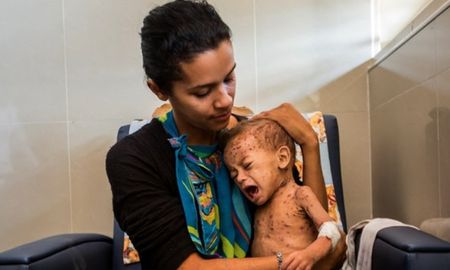Advirtieron que los niños pueden enfrentarse a desnutrición aguda a causa de la pandemia del coronavirus. Advirtieron que los niños pueden enfrentarse a desnutrición aguda a causa de la pandemia del coronavirus.