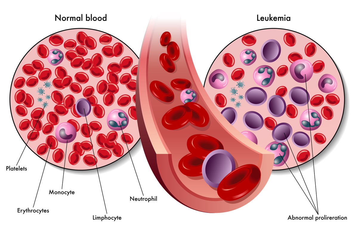 La leucemia también puede causar síntomas en órganos que han sido infiltrados o afectados por células cancerosas. La leucemia también puede causar síntomas en órganos que han sido infiltrados o afectados por células cancerosas.