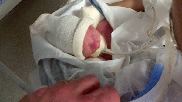 La prematurez es la principal causa de ingreso a las Salas de Neonatología, y constituye uno de los factores más importantes de mortalidad infantil.