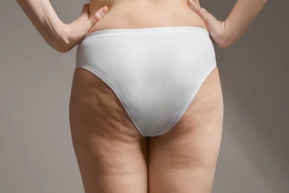 Los pantalones ajustados pueden causar celulitis: razones para darle un respiro a las piernas