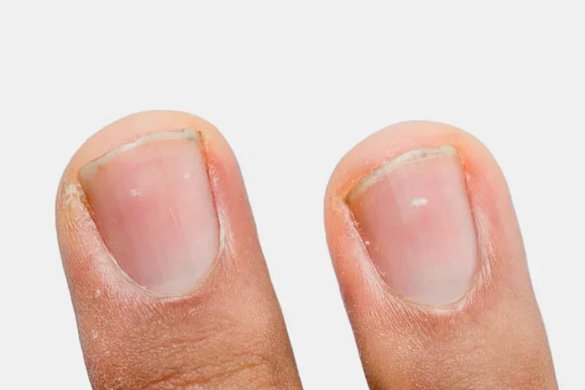 Pueden ser varias las causas que originan una alteración en la matriz de la uña, que es la región donde ella se forma, causando así la aparición de manchas blancas.