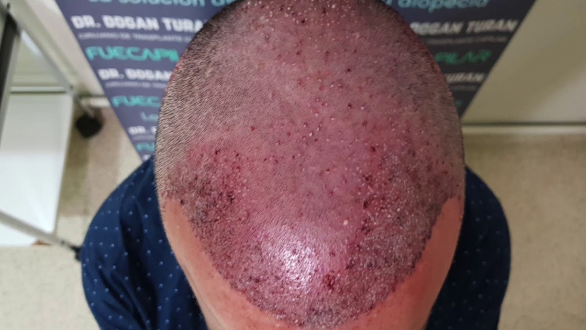 Era pelado, viajó para hacerse un trasplante de pelo, se descompensó en plena operación y no pudieron revivirlo