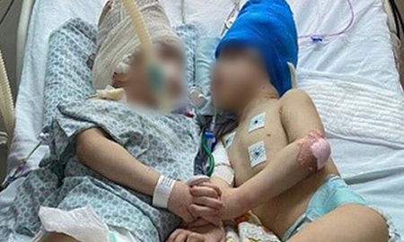 Brasil: separaron a siameses brasileños que estaban unidos por la cabeza con un sorprendente método Brasil: separaron a siameses brasileños que estaban unidos por la cabeza con un sorprendente método