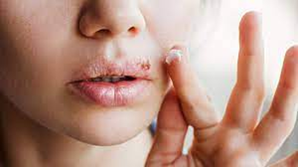 10 tratamientos naturales contra el herpes labial