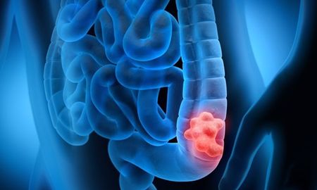 El cáncer de colon y recto es un tumor maligno que se desarrolla en la última parte del tubo digestivo El cáncer de colon y recto es un tumor maligno que se desarrolla en la última parte del tubo digestivo