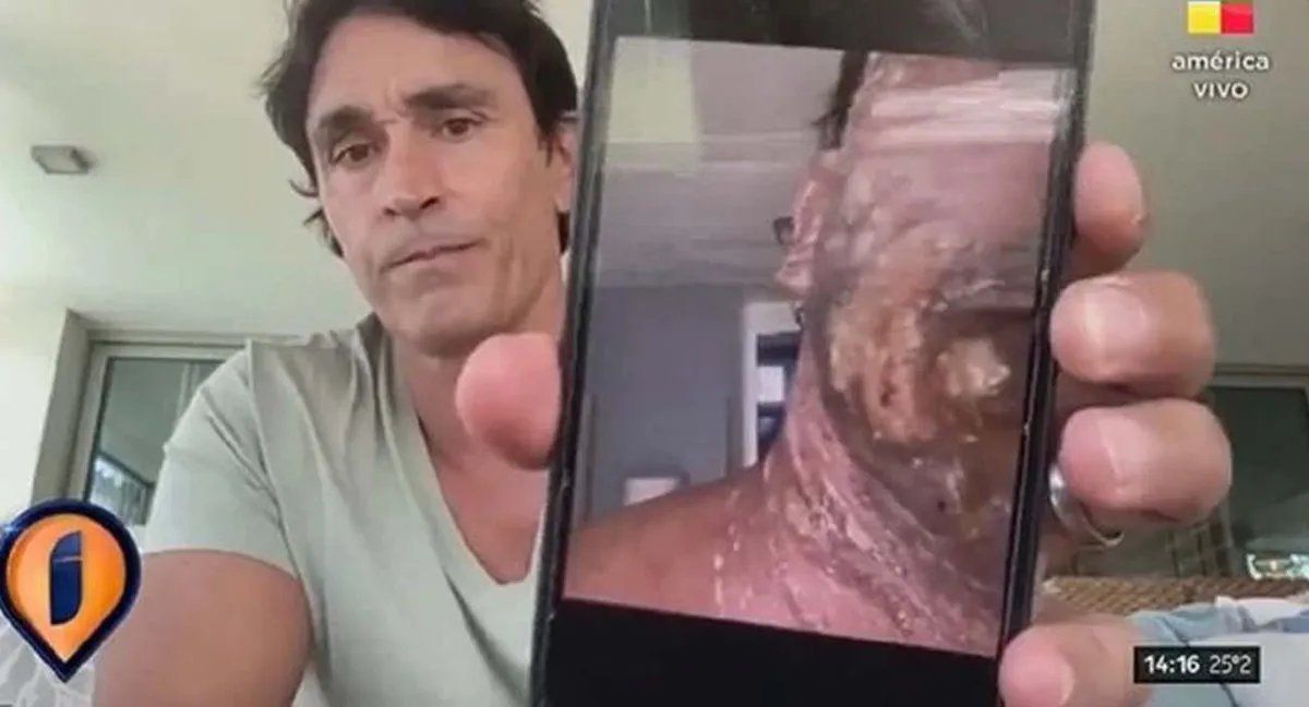 Sebastián Estevanez reapareció a siete meses del accidente doméstico con fuego que puso en serio riesgo su vida.