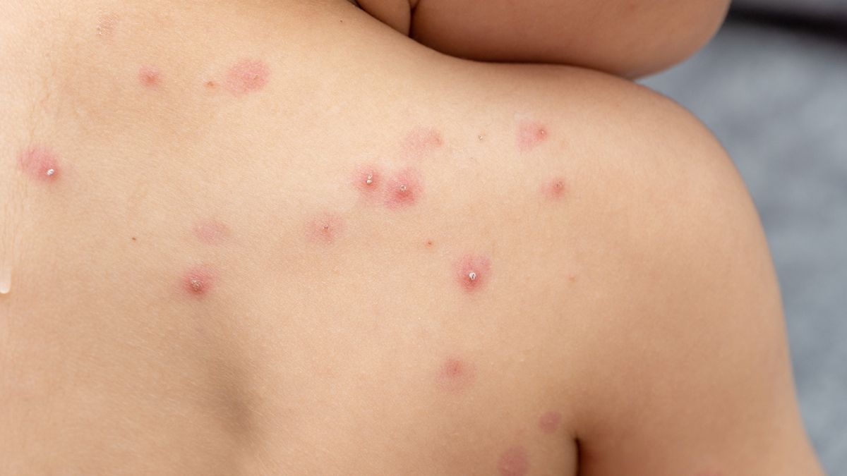 Aún se desconoce el origen del brote de la viruela del mono