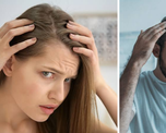 La pérdida de cabello es una de las consultas más frecuentes en dermatología.